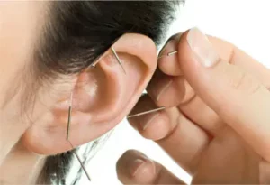 Acupuntura del oído